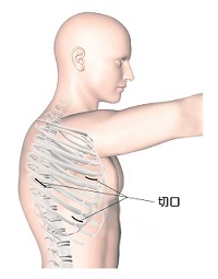 傳統胸腔鏡手術